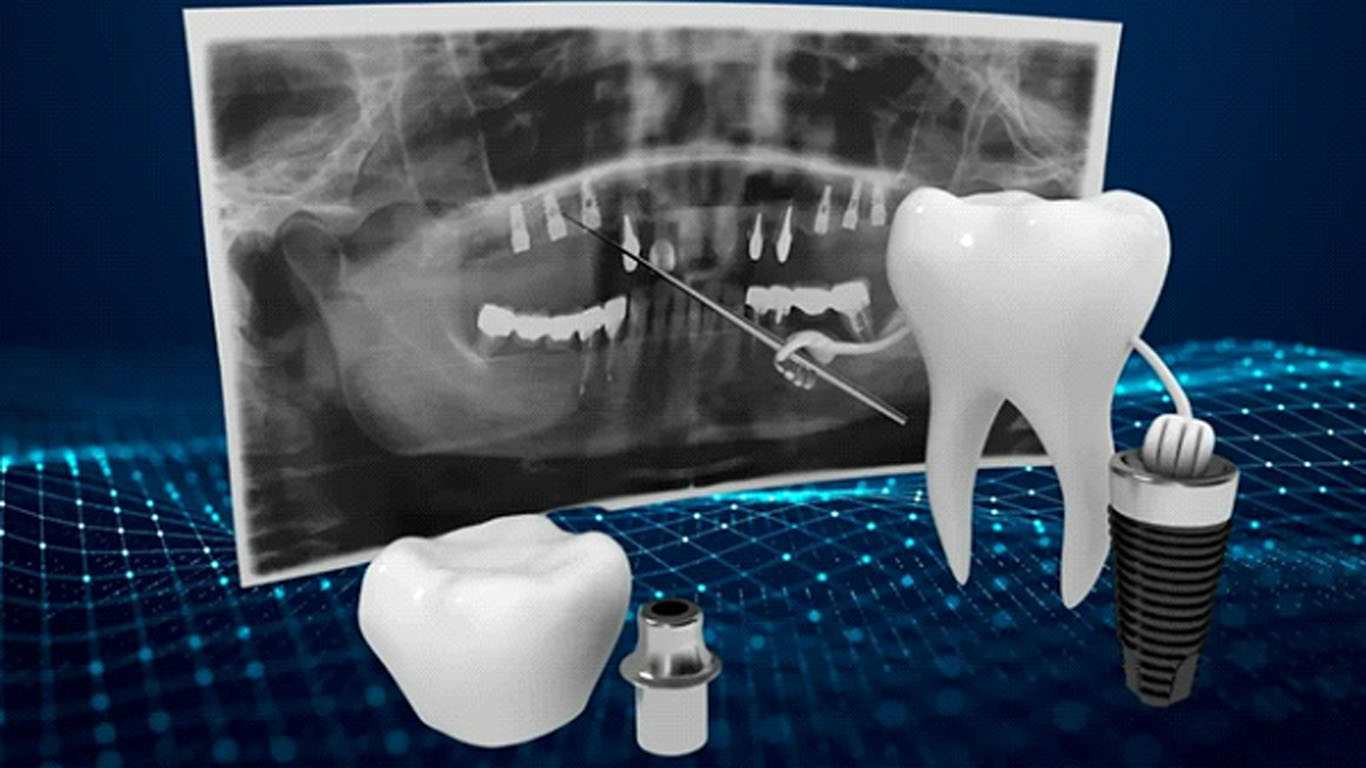 روش‌ های دیجیتال و ارتقا علم ایمپلنتولوژی